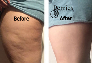 Shop as Bundle & Save- No1 Stretch Mark Proof & No2 Cellulite Proof - BerriesSkinCare